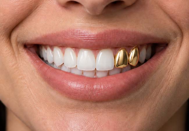Grillz uygulanmış ağız görünümü